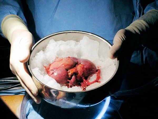 Трансплантологія: трохи лікнепу