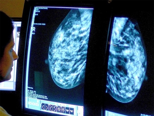 У США вчені змогли вилікувати рак грудей на останній стадії