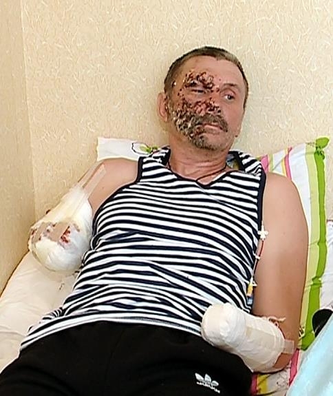 Бойцу, который защищал Донецкий аэропорт и потерял обе руки, нужна помощь на лечение