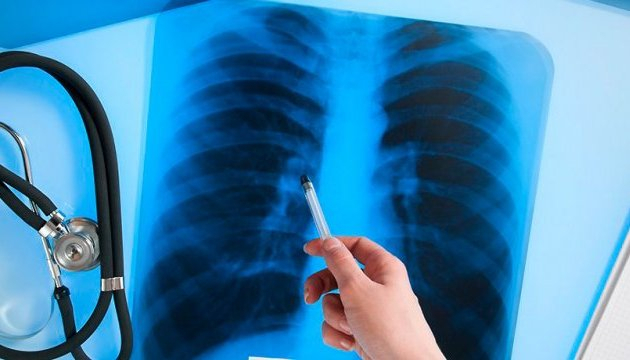 ООН: Украина заняла второе место по уровню заболеваемости туберкулезом