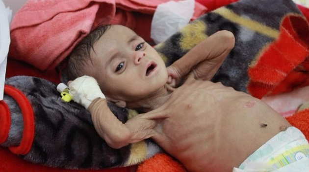 85 тисяч дітей загинули від голоду в Ємені за останні три роки, - Save the Children