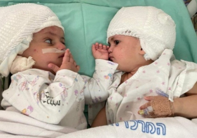 В Израиле хирурги впервые разделили сиамских близнецов