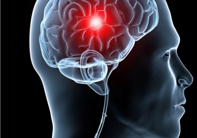 Пухлину мозку вперше вдалося зменшити за допомогою магнітного шолома