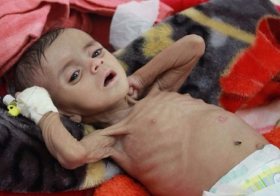 85 тисяч дітей загинули від голоду в Ємені за останні три роки, - Save the Children