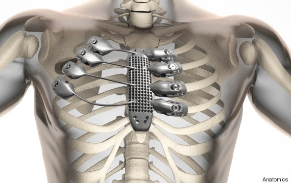 Мужчине имплантировали распечатанную на 3D-принтере грудную клетку