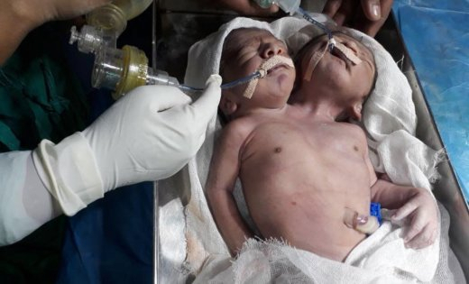 В Індії народилася дитина з двома головами 