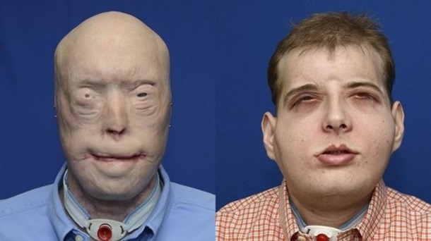У США провели унікальну операцію із повної пересадки обличчя, - ФОТО