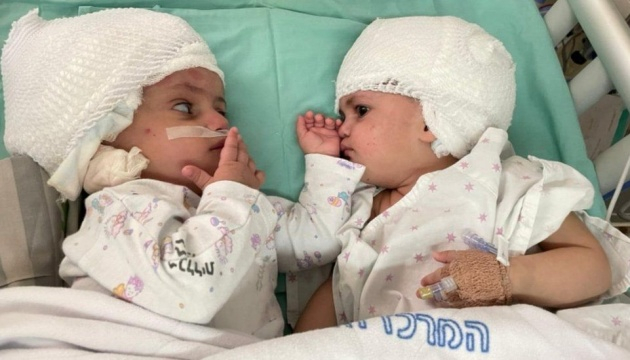 В Израиле хирурги впервые разделили сиамских близнецов