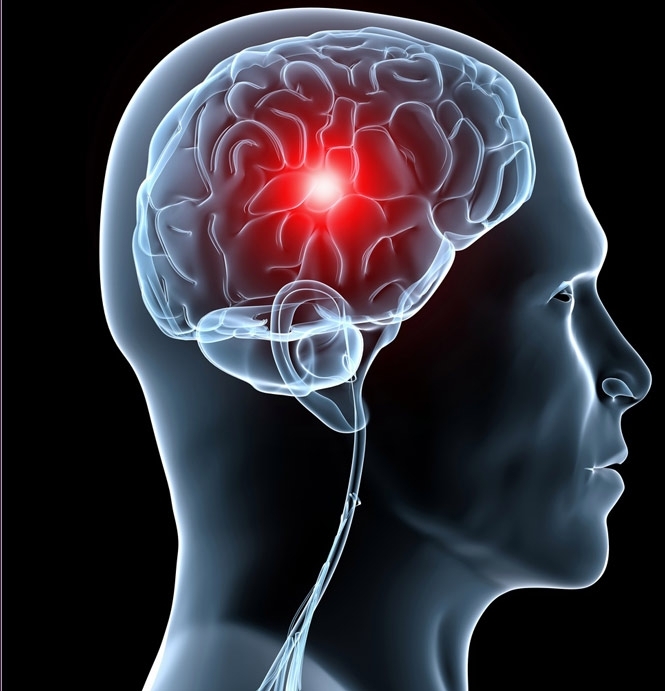 Пухлину мозку вперше вдалося зменшити за допомогою магнітного шолома