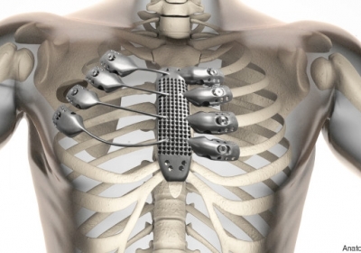 Мужчине имплантировали распечатанную на 3D-принтере грудную клетку
