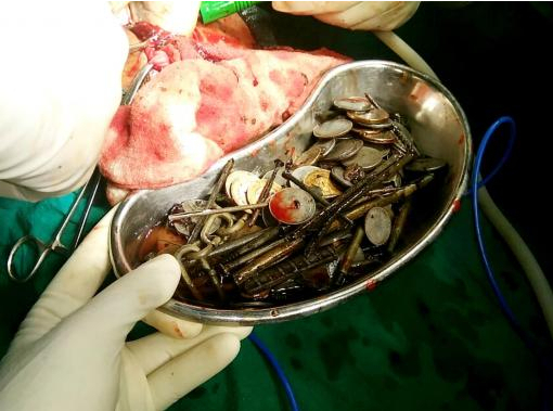 Индийские хирурги достали из желудка пациента семь килограммов металла, - ФОТО