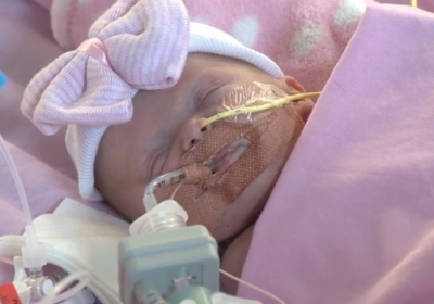 В Британии прооперировали младенца, рожденного с сердцем снаружи