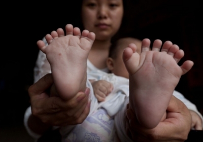 В Китае родился мальчик с 31 пальцем - ФОТО
